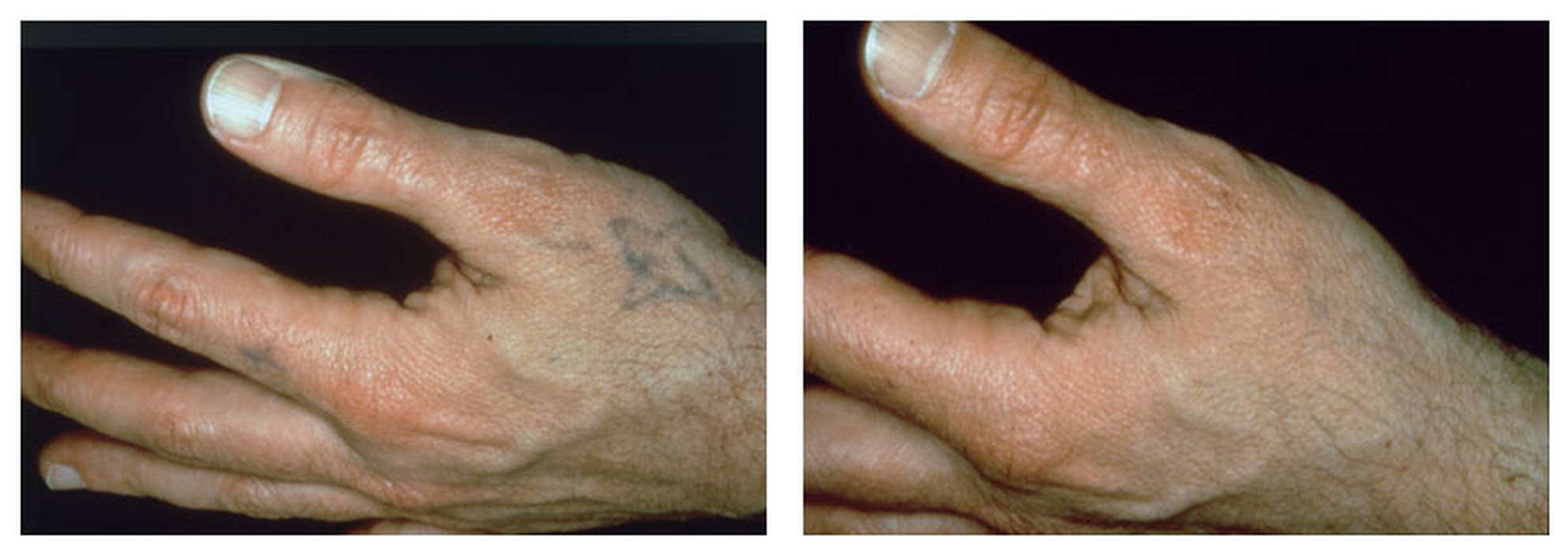 Alex-Trivantage Αφαιρεση Τατουάζ