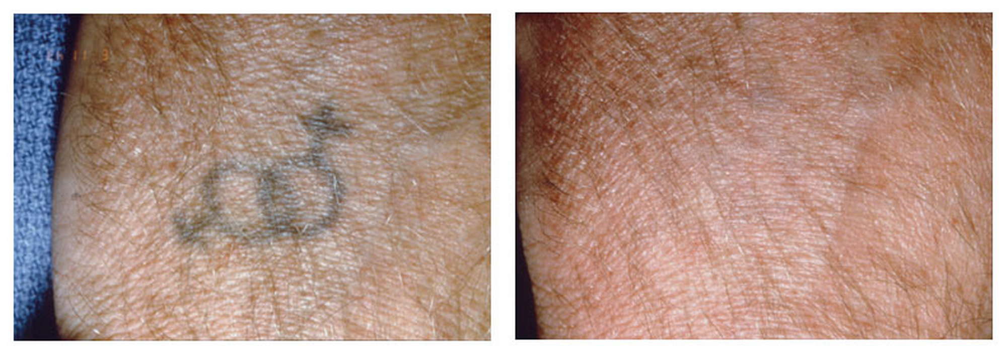 Alex-Trivantage Αφαιρεση Τατουάζ