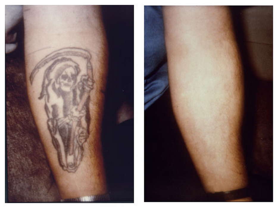 Alex-Trivantage Αφαιρεση Τατουάζ