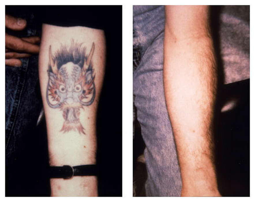 Alex-Trivantage Αφαιρεση Τατουάζ