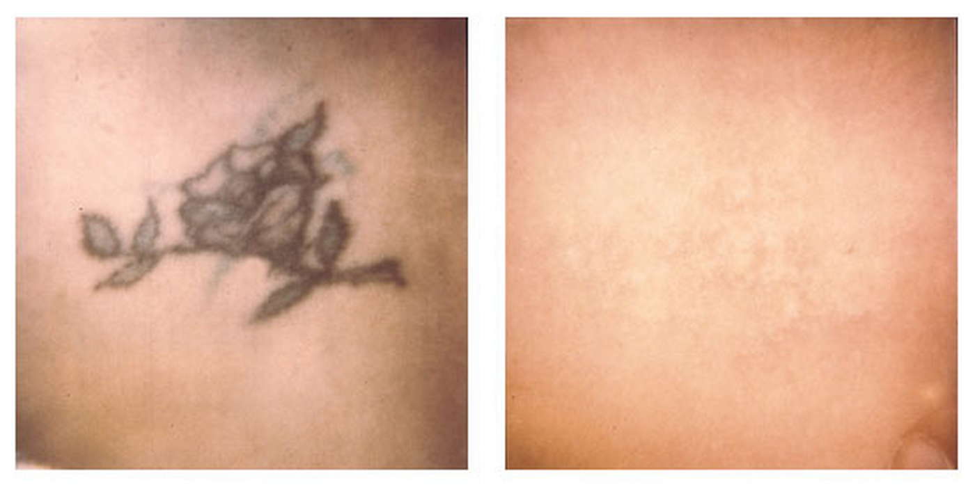 Alex-Trivantage Αφαιρεση Τατουάζ