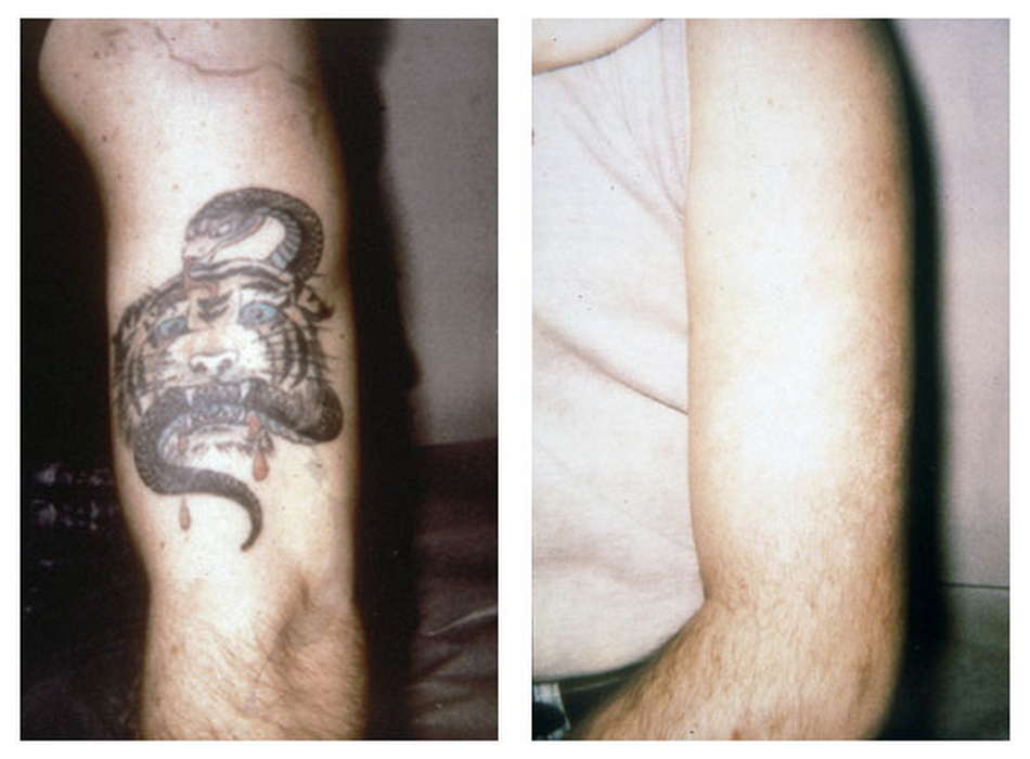 Alex-Trivantage Αφαιρεση Τατουάζ