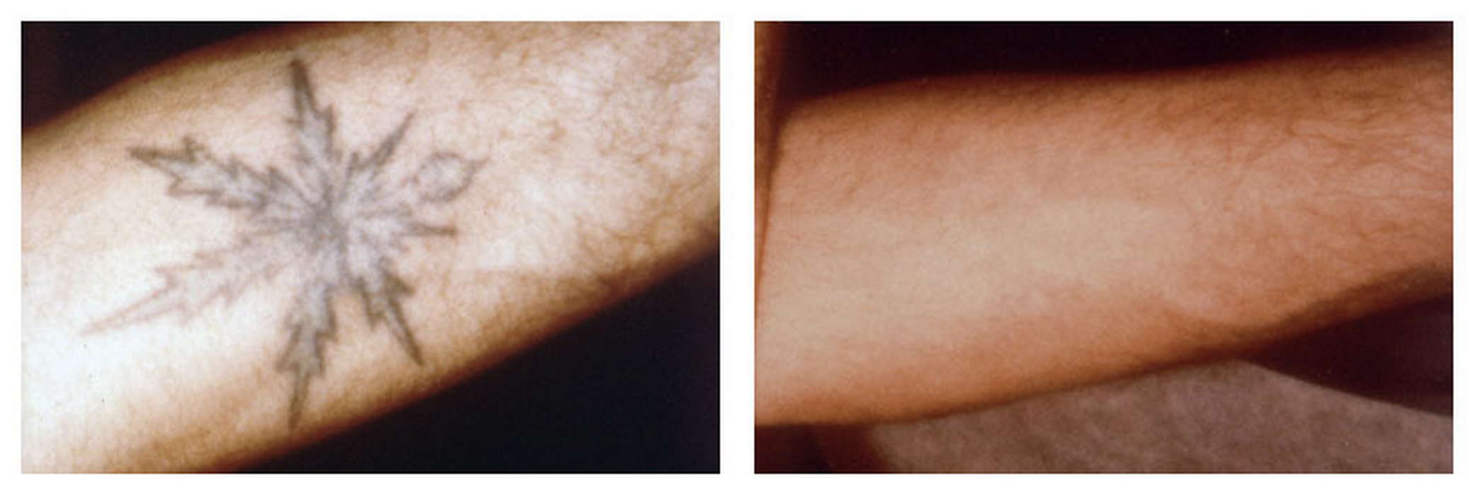 Alex-Trivantage Αφαιρεση Τατουάζ